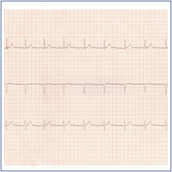 Electrocardiogram